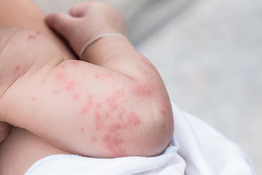 Dr. Yeung Ho Hong(楊浩康) explains Urticaria