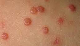 Dr. Yeung Ho Hong(楊浩康) explains infectious molluscum contagiosum