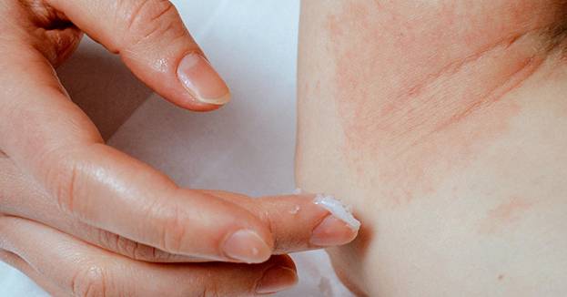 Dr. Yeung Ho Hong(楊浩康) explains Topical Creams for Treating Eczema?