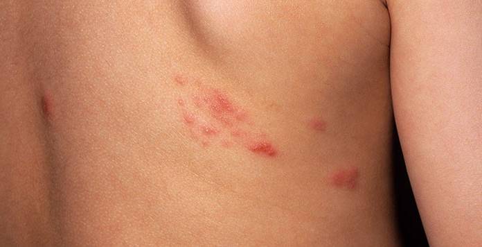 Dr. Yeung Ho Hong(楊浩康) explains the Shingles