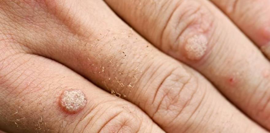 Dr. Yeung Ho Hong(楊浩康) explains warts