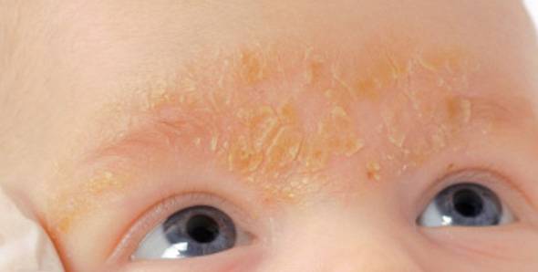 Dr. Yeung Ho Hong(楊浩康) explains what is seborrheic dermatitis？