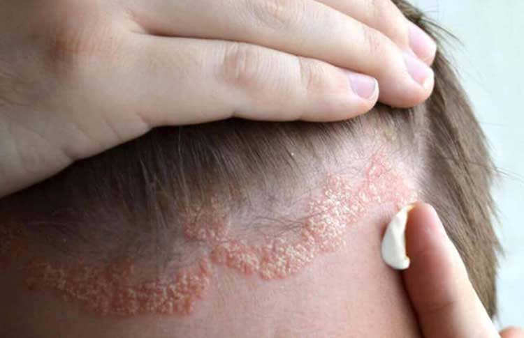 Dr. Yeung Ho Hong(楊浩康) explains how to treat seborrheic dermatitis